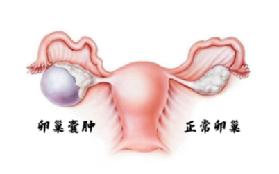 卵巢囊肿